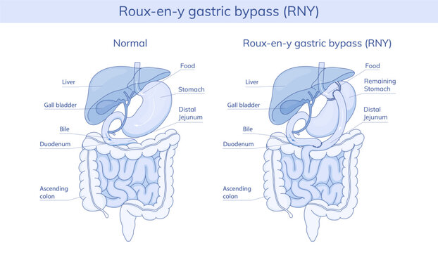 Roux-en-Y gastric bypass. Vector illustration
