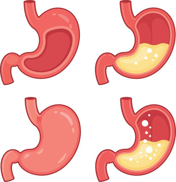 Stomach anatomy diagrams illustrate healthy and acidic conditions for medical reference.