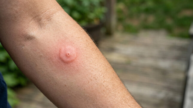 Swollen bee sting reaction on human arm outdoors with greenery background  