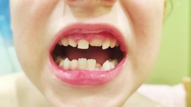Close-up of a child smiling with mixed dentition, baby teeth and emerging permanent teeth, touching a loose tooth with the tongue