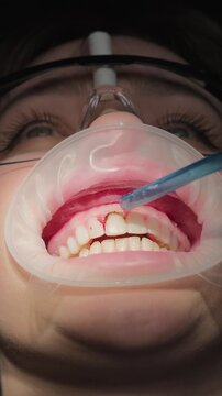 Close-up of gingival contouring with gum coagulation to reshape gum line. Dentist performing soft tissue correction for aesthetic dentistry in clinic. Dental treatment concept. Vertical video.