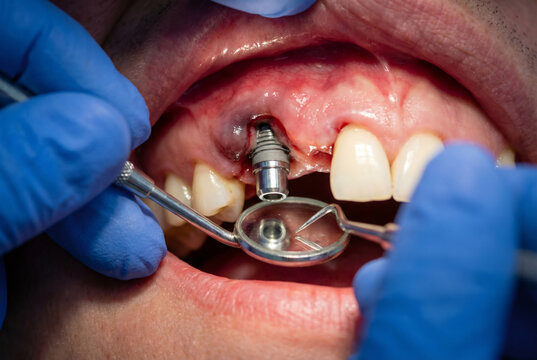Macro close-up of a dental implant failed rejection gum showing infection and bruising in a patient mouth for medical training and healthcare marketing