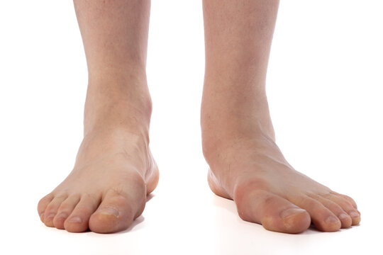 Close-up of bare adult feet showing flat-footed arch and ankle on a white background, useful for foot health, podiatry, or orthopedic contexts.