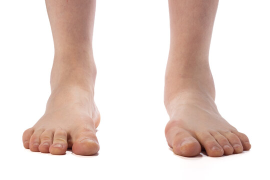 Close-up of bare adult feet showing flat-footed arch and ankle on a white background, useful for foot health, podiatry, or orthopedic contexts.