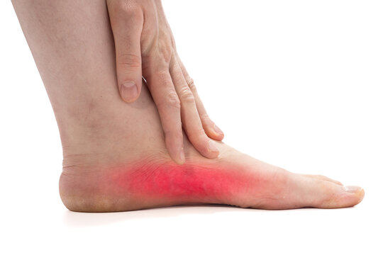 Close-up of a foot with flat arch showing red inflamed area along the sole near the heel, hand touching the midfoot on a white background.