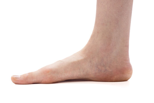 Close-up of a human foot with a low medial arch resting on a white background, illustrating flat feet and related ankle/plantar conditions.