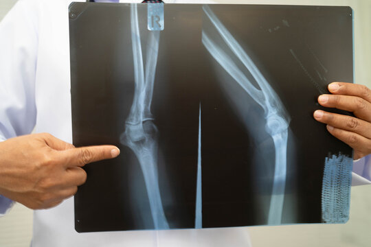 Doctor examining knee joint bone radiography xray film.