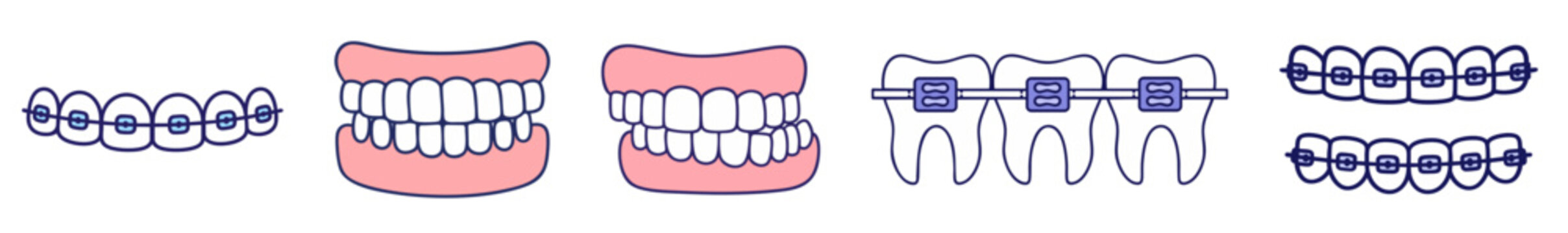 Orthodontic Braces and Bite Alignment Set, Dental Bracket System on Teeth, Correct and Incorrect Occlusion, Tooth Straightening Process and Jaw Alignment