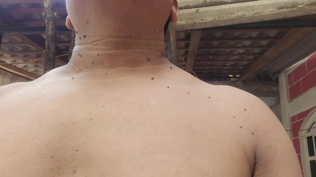 Close up of skin tags and warts on neck and chest area