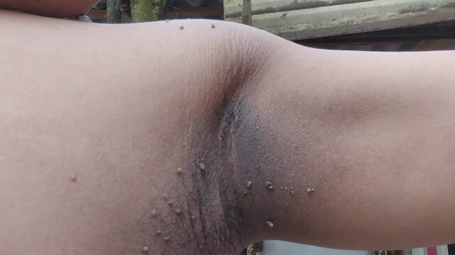 Dermatological view of skin tags and warts in the armpit area