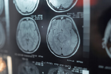 Close up of brain MRI scans displaying diagnostic imaging for neurological examination and clinical...