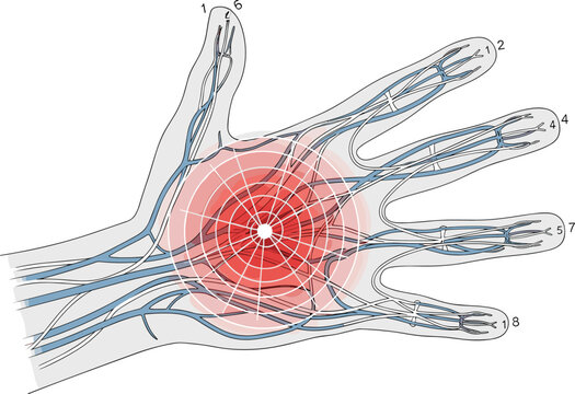 Medical anatomical vector illustration of human hand showing nerve pain carpal tunnel syndrome inflammation and palm injury with red glowing circular ache signal