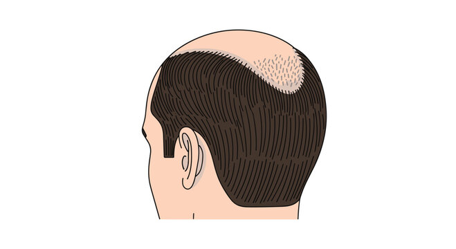 The back of a man's head shows a receding hairline and a distinct bald patch at the crown in a clean illustration against a stark white background area.