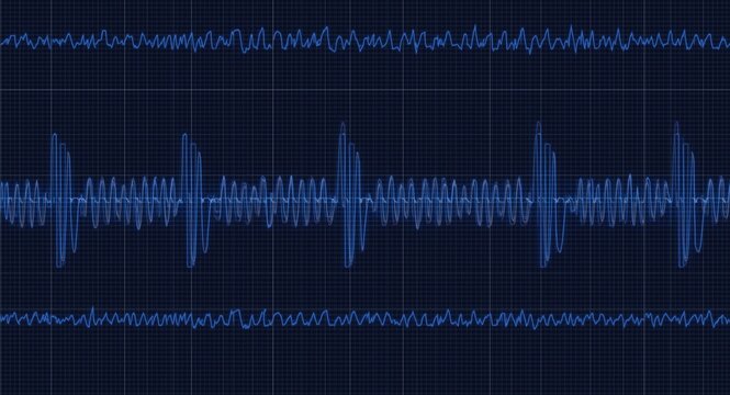 Visualizing epileptic sharp wave EEG patterns in patients between seizure events