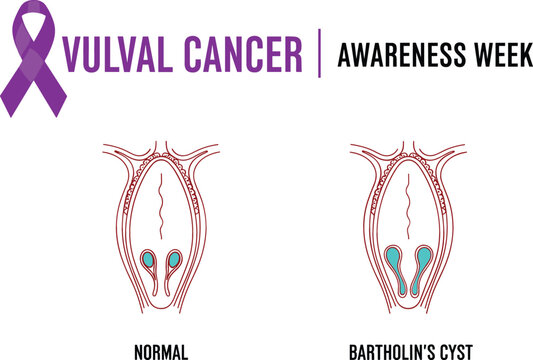Vulval Cancer Awareness Week Infographic Featuring Purple Ribbon Symbol and Comparative Anatomy Diagrams of Normal Glands Versus Bartholin's Cyst for Medical Educational Materials