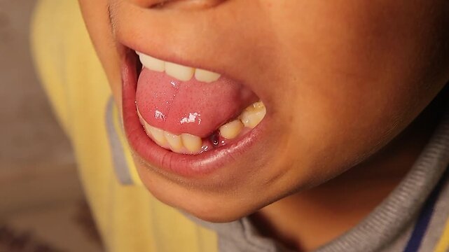 Fresh extraction socket visible in a child&rsquo;s mouth just two minutes after tooth loss, with light bleeding in the tooth socket (dental socket). Ideal for pediatric dentistry and oral health education.