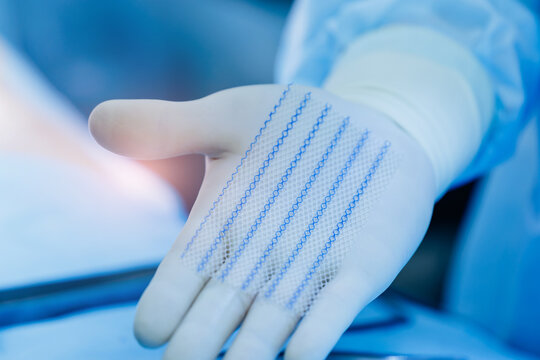 Close-up of surgical hand in gloves holding medical mesh suture material in operating room after umbilical hernia removal