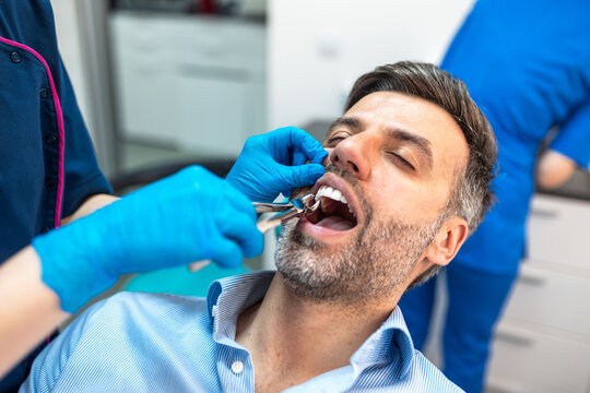 Tooth extraction with pliers. Professional dentist removing a tooth from a male patient in a modern dental clinic, Healthcare and Medicine concept. Close up of surgical procedure in dentistry office.