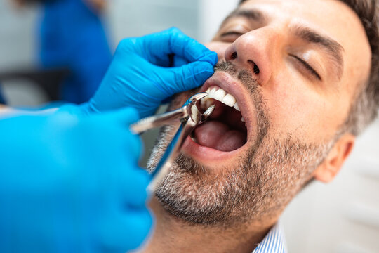 Tooth extraction procedure. Professional dentist using surgical pliers to remove a patient's tooth in clinic, Healthcare and Medicine concept. Close up of male patient with open mouth at dentistry.