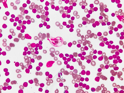 Chronic lymphoproliferative disease. Mature looking lymphocytes, scant cytoplasm, condensed chromatin, frequent smudge cells. Microscopic image of blood cells. 