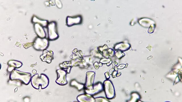 Calcium oxalate monohydrate crystals and dihydrate in urine under microscope.
