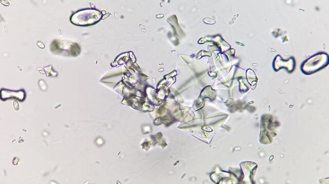 Calcium oxalate monohydrate crystals and dihydrate in urine under microscope.