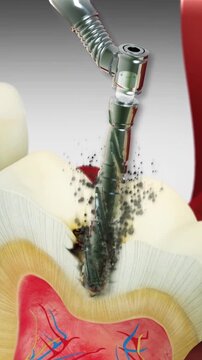 Dental filling - Amalgam. Medically accurate 3D animation.	
