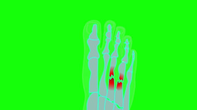 Broken foot bones x ray, roentgen sample green screen animation. Top foot xray big toe symptom structure.  Feet anatomy. Medical video