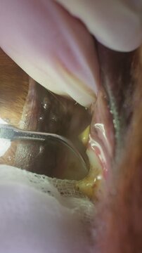 A close-up of a dog being brushed under anesthesia using a scaler to remove plaque and tartar to improve oral hygiene and health. Vertical video.
