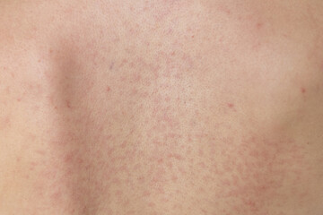 Naklejka premium Skin condition shows spots from possible irritation or allergic reaction on human skin in a close-up shot taken indoors