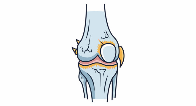 Cartoon depiction of a damaged human knee joint with inflammation and bone spurs
