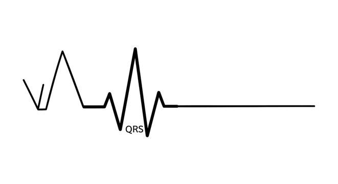ECG flatline showing cardiac arrest on a heart monitor.