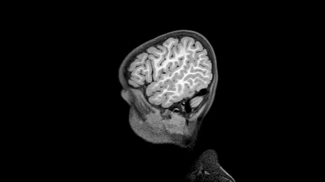 Brain MRI footage capturing axial slices with clear visualization of cerebral anatomy and neural structures. Advanced diagnostic imaging video suitable for neuroscience and hospital presentations.