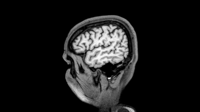 Dynamic MRI video of human brain highlighting internal structures and soft tissue contrast in grayscale imaging. Professional radiology footage useful for medical research, education, and clinical ana