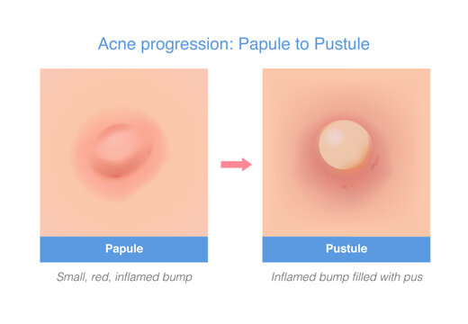 Acne progression from Papule to Pustule. Medical illustration compare the difference of acne types and show before and after steps. Dermatology education diagram.