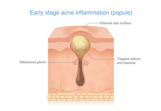 Skin layer anatomy of papule acne. Early stage acne inflammation. Clogged pore by trapped sebum and bacteria. Inflamed skin surface small red, swollen bump without visible pus.