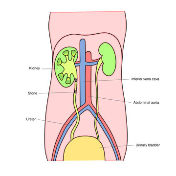 Kidney Stone