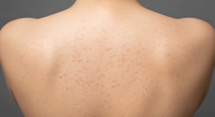 Naklejka premium Person with acne on their back against a gray background