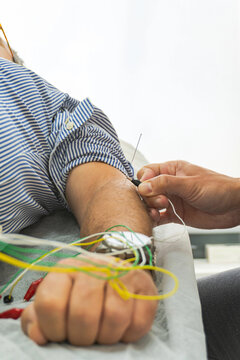 Close up of dry needling with electrical stimulation on arm
