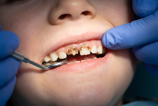 Pediatric dentist examining baby bottle tooth decay infant front teeth with a mirror for medical education and healthcare training