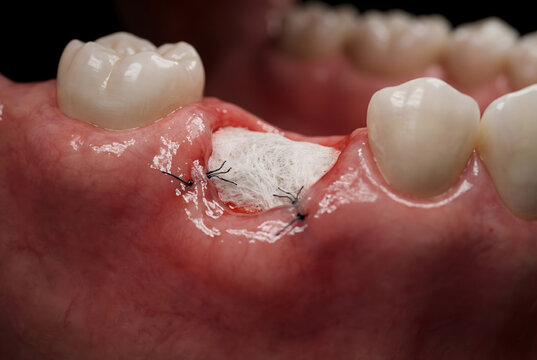 Bone graft membrane exposed jaw surgery procedure with sutures in human mouth for dental implant training