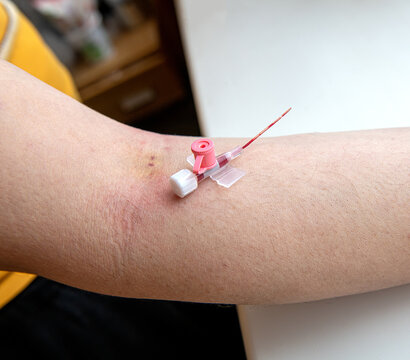 Human arm with visible marks immediately after intravenous cannula needle removal