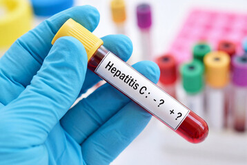 Obraz premium Hand in blue medical glove holding a test tube with blood labeled hepatitis c for medical testing