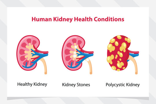 vector illustration of 3 kidney conditions. healthy kidney, kidney stones, polycystic kidney.
polycystic kidney disease illustration renal cysts.
