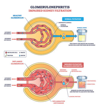 Glomerulonephritis impaired kidney filtration contrasts healthy vs inflamed glomerulus, Bowmans capsule, and urine sample to show leakage, proteinuria, and hematuria. Outline diagram