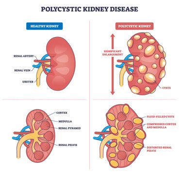 Polycystic kidney disease diagram shows enlarged kidney with fluid-filled cysts, comparing healthy vs PKD, highlights cortex, medulla, renal pelvis. Outline diagram