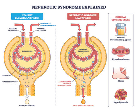Nephrotic syndrome overview, side-by-side glomeruli show healthy vs leaky filter leading to proteinuria, key objects, glomerulus, albumin leak, urine drop. Outline diagram