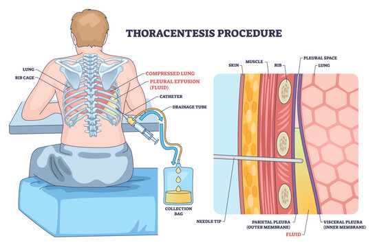 Thoracentesis procedure outline shows fluid removal from pleural space, patient seated, needle catheter enters between ribs to drain effusion into collection bag. Outline diagram