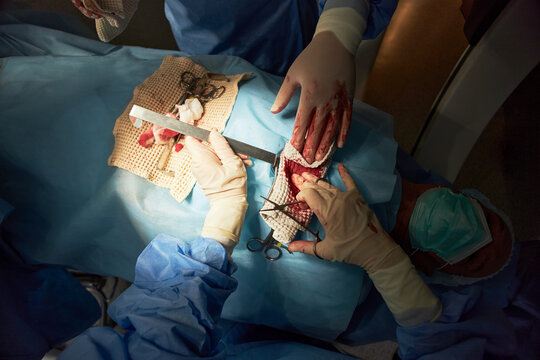 Overhead shot of surgeons performing open chest operation, pressing on bloody wound and handling instruments in operating room. Useful for healthcare, orthopedic surgery, trauma care campaigns