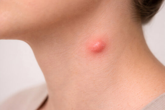 Photorealistic dermatology clinical: lymphocutaneous sporotrichosis&mdash;one small subcutaneous nodule near wrist with a short linear chain of 2&ndash;3 proximal nodules along lymphatics, mild erythema